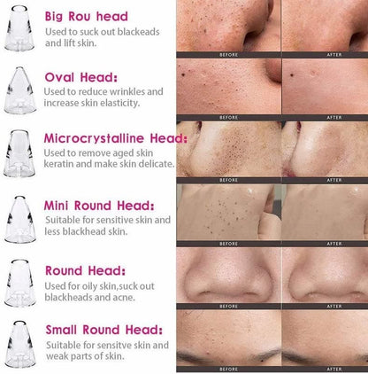 Rechargeable Vacuum Pore Cleaner, 5 In 1 Blackheads Removing Device Electric Derma suction Machine | USB Rechargeable Acne Pimple Pore Cleaner Vacuum tool - Facial Cleanser Device for Nose & Skin Care